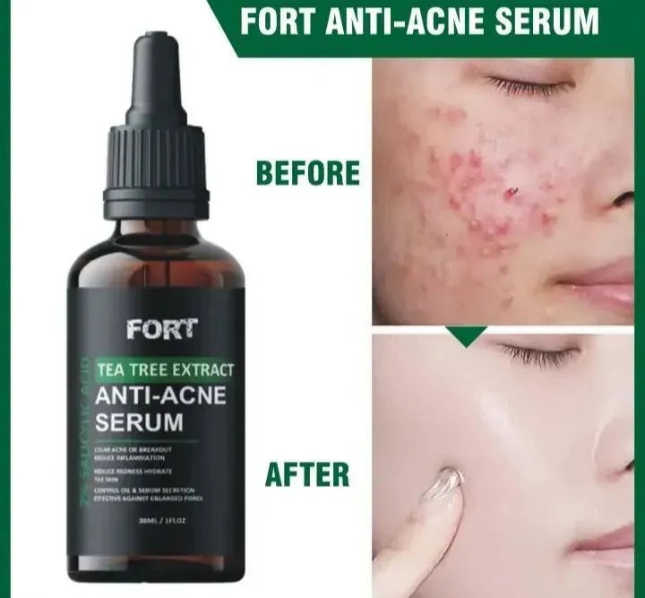 Anti Acne Face Serum for Clear & Glowing Skin – Oil Control Tea Tree Serum 30ml - Smart Hud